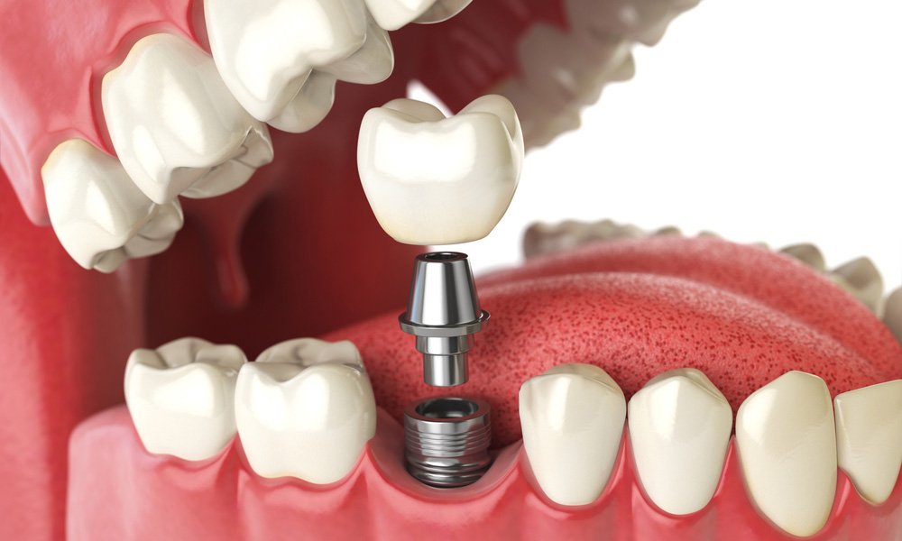Dental implant model